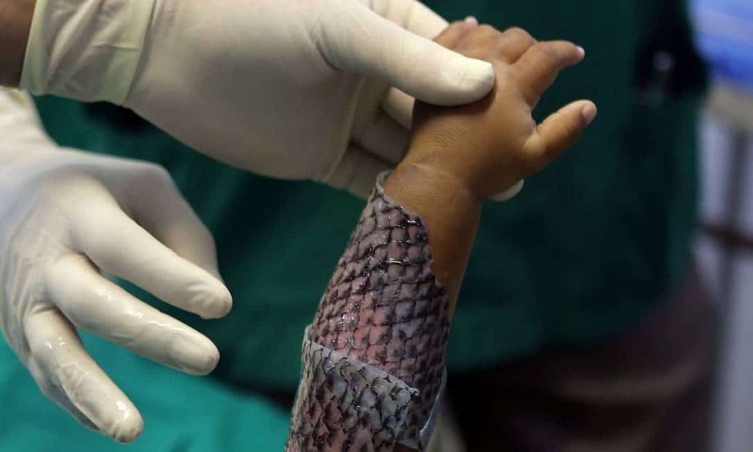 Conheça o método da Pele de Tilápia para queimadura criado no Brasil -  Sanarmed